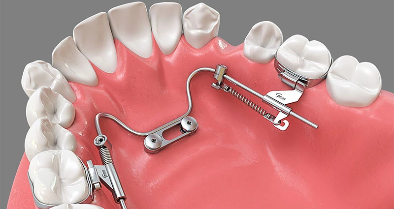 PSM Medical Coil spring with eyelet